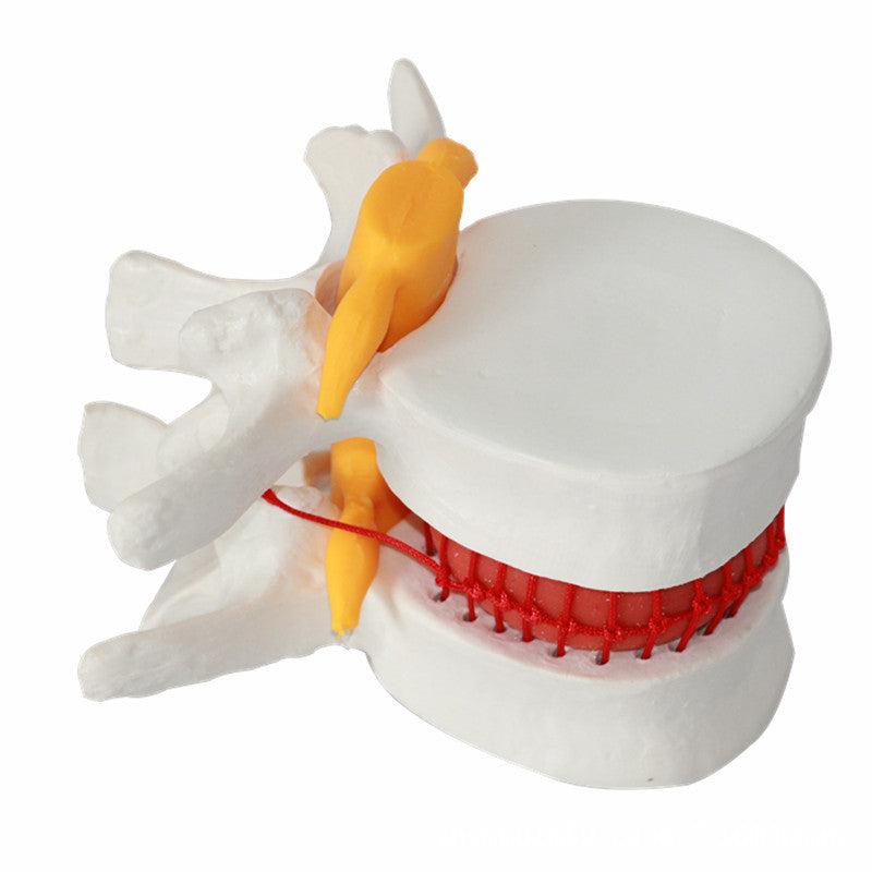 Demonstration Model Of Medical Human Lumbar intervertebral Disc