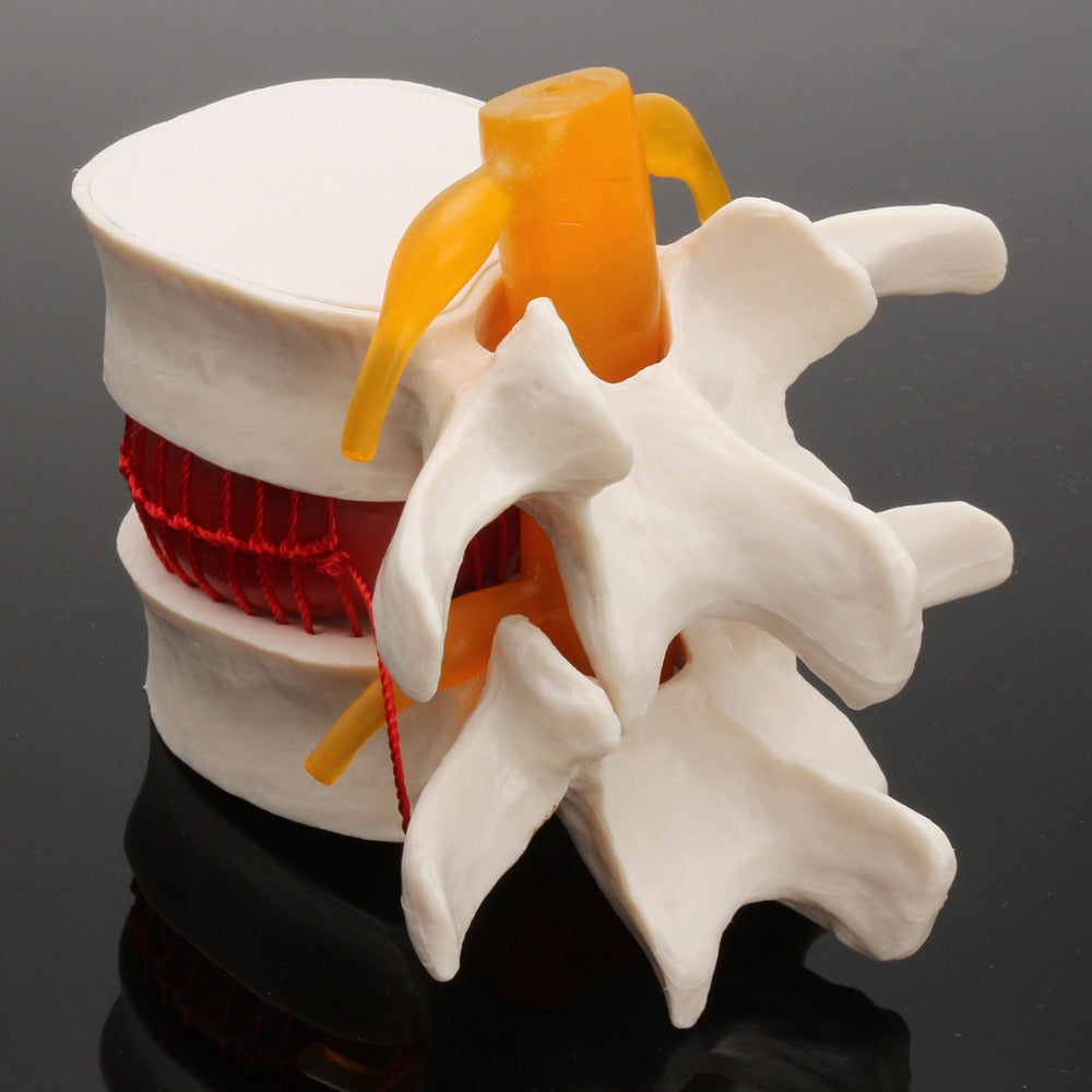 Demonstration Model Of Medical Human Lumbar intervertebral Disc