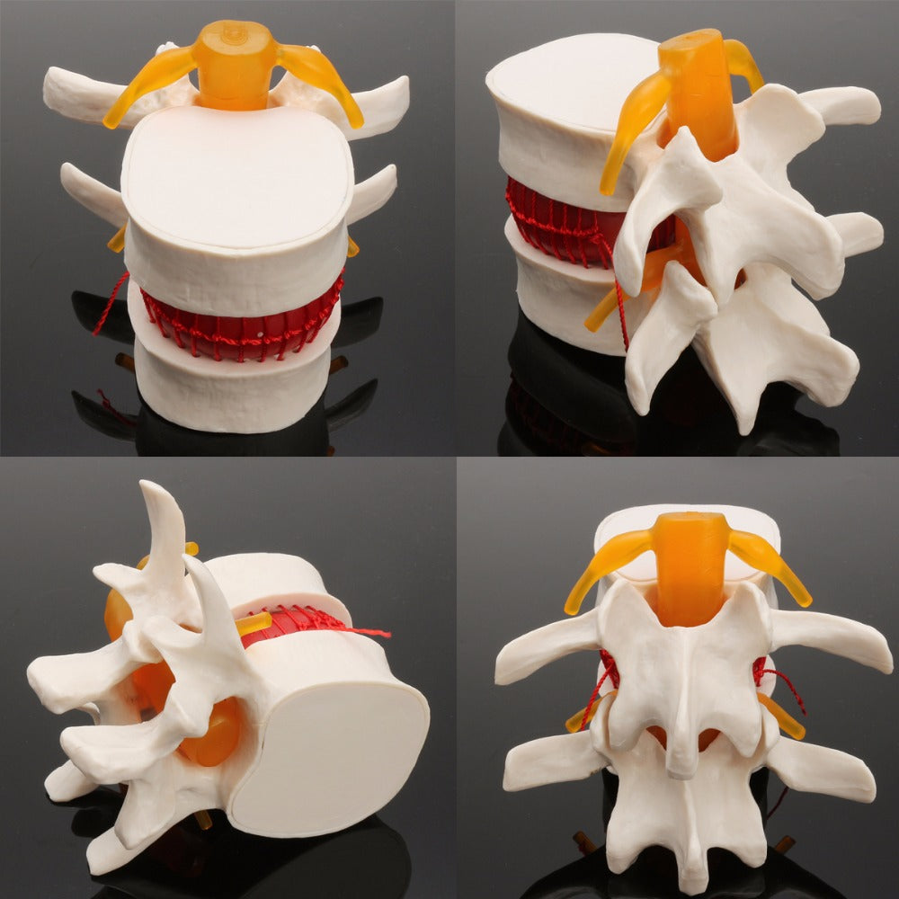 Demonstration Model Of Medical Human Lumbar intervertebral Disc